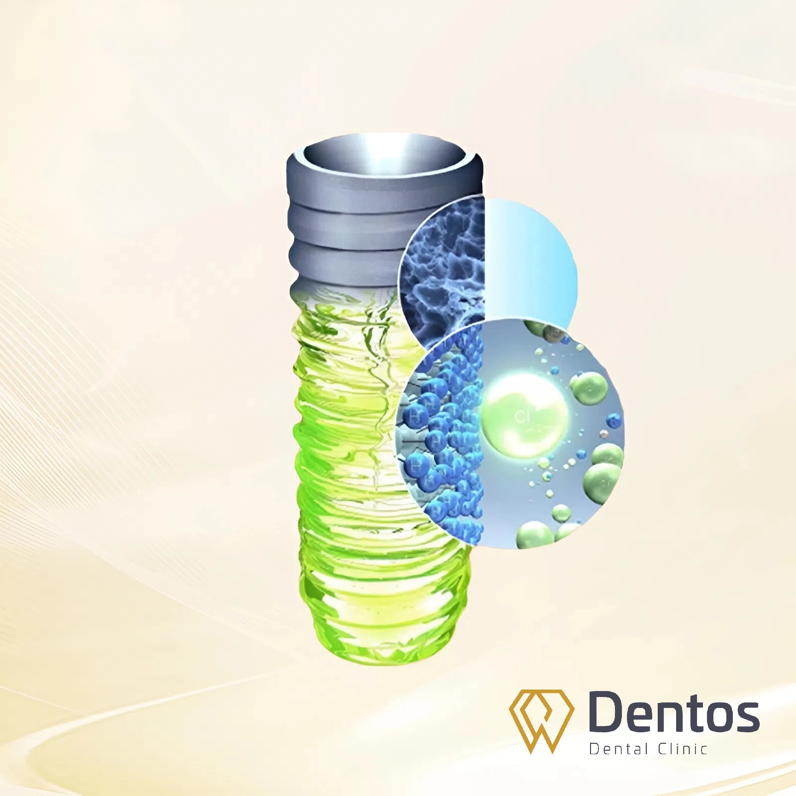 Implant Straumann SLA được chế tác từ Titanium tinh khiết, tương thích sinh học hoàn hảo